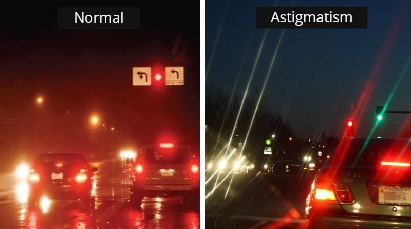 Astigmatism