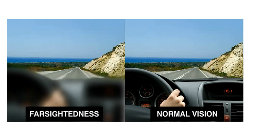 Farsightedness, Hyperopia