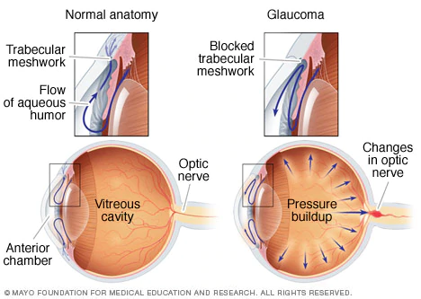 Glaucoma