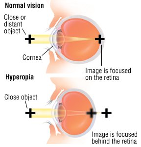 Farsightedness, Hyperopia