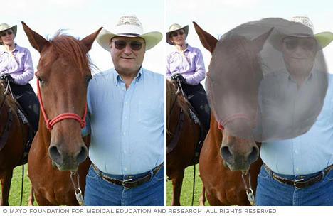 Age-Related Macular Degeneration